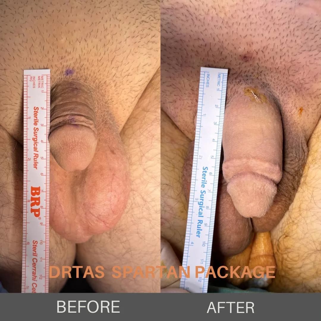 Penile enlargement case 5, before and after